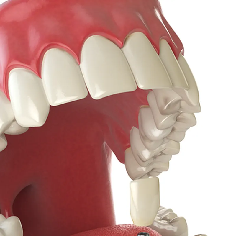 Upper front teeth on a dental model